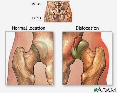 dislokasi panggul kongenital